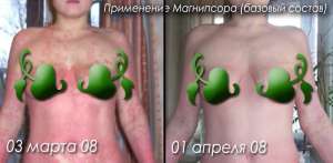 Псориаз мазь Магнипсор и масло черного тмина - объявление
